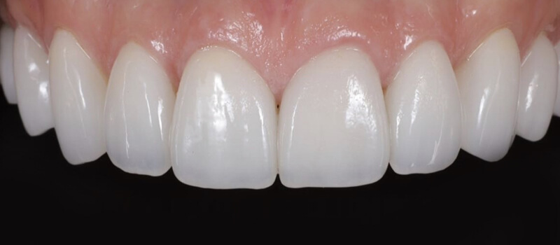 After - Veneers at Quail Lakes Dental Care