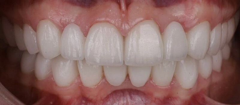 After - Veneers at Quail Lakes Dental Care
