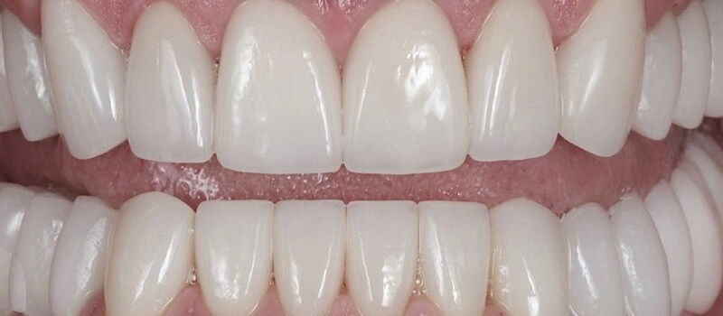 After - Veneers at Quail Lakes Dental Care