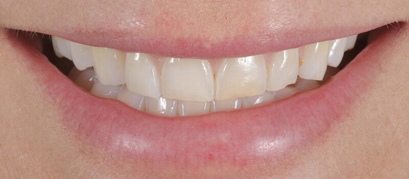 Before - Veneers at Quail Lakes Dental Care
