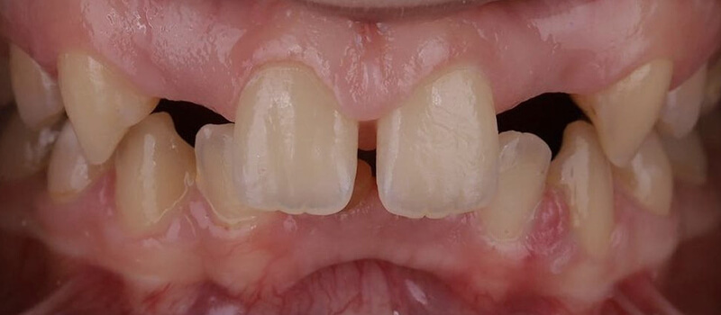 Before - Veneers at Quail Lakes Dental Care