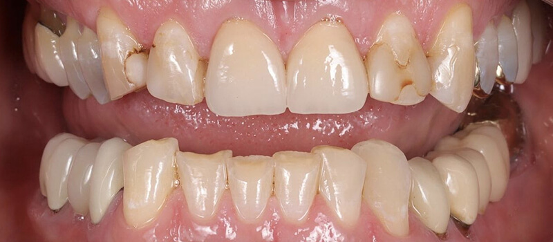 Before - Veneers at Quail Lakes Dental Care
