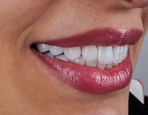 Dental Veneers