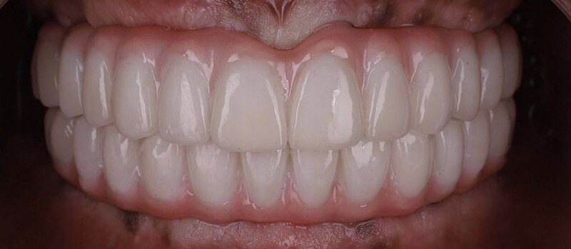 After - All-on-4 at Quail Lakes Dental Care