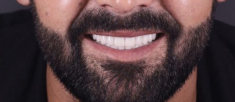 After - All-on-4 at Quail Lakes Dental Care