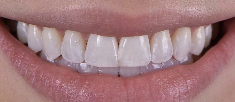 After - Invisalign at Quail Lakes Dental Care