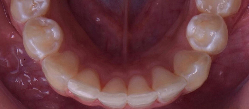 After - Invisalign at Quail Lakes Dental Care