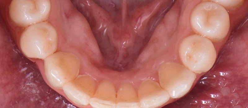 After - Invisalign at Quail Lakes Dental Care