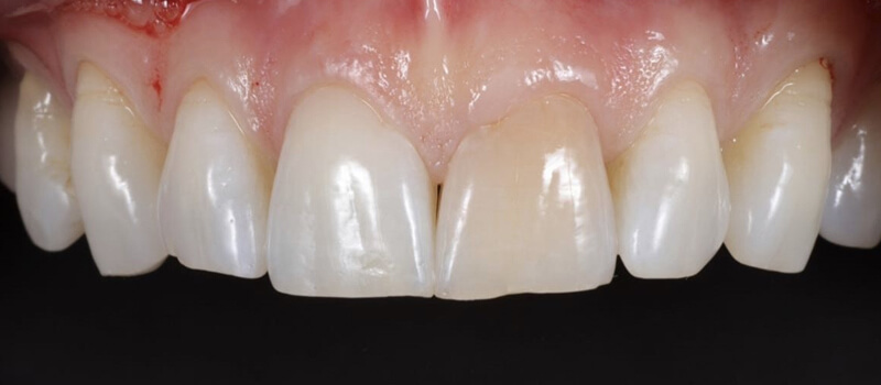 Before - Veneers at Quail Lakes Dental Care