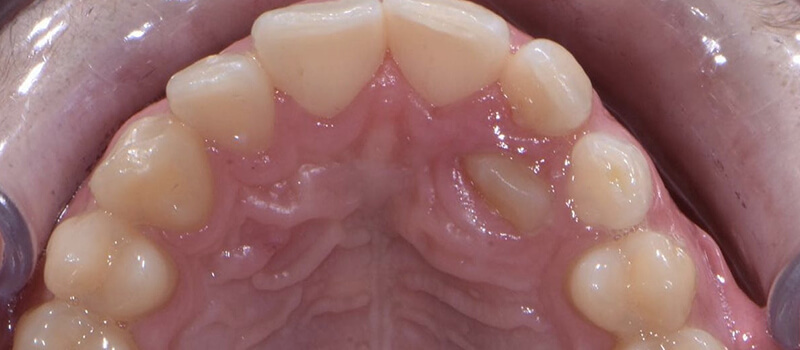 Before - Braces at Quail Lakes Dental Care