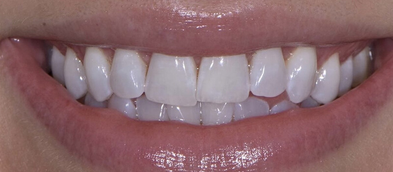 Before - Invisalign at Quail Lakes Dental Care
