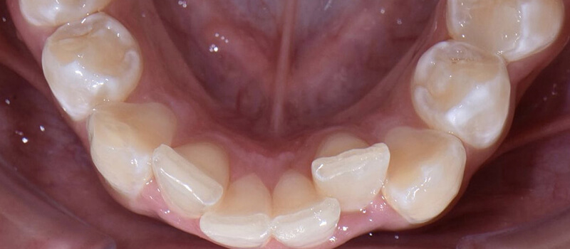 Before - Invisalign at Quail Lakes Dental Care