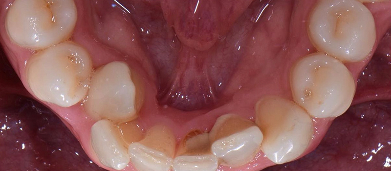 Before - Invisalign at Quail Lakes Dental Care