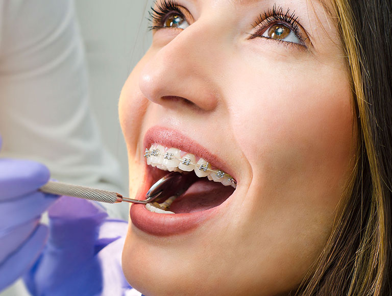 Metal braces