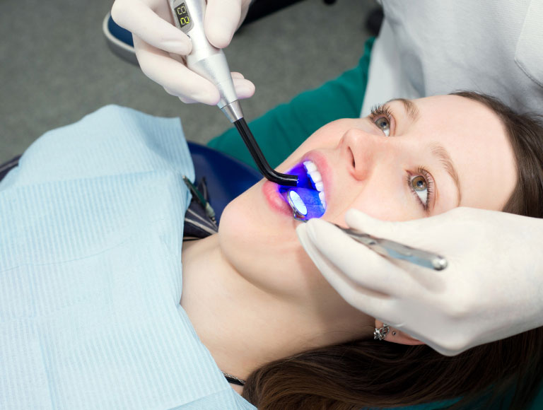 Dental Filling
