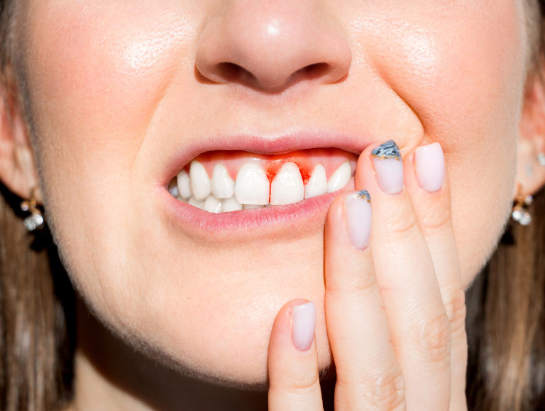 Gum Disease