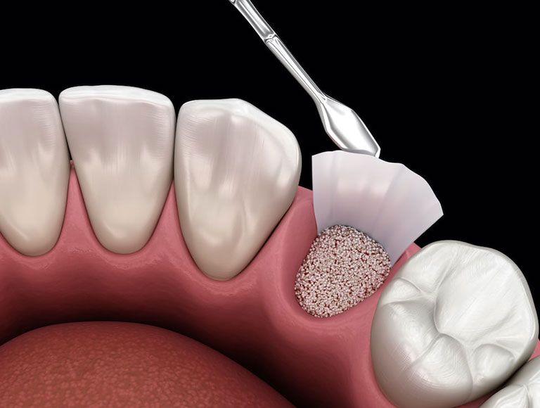 Bone Grafting