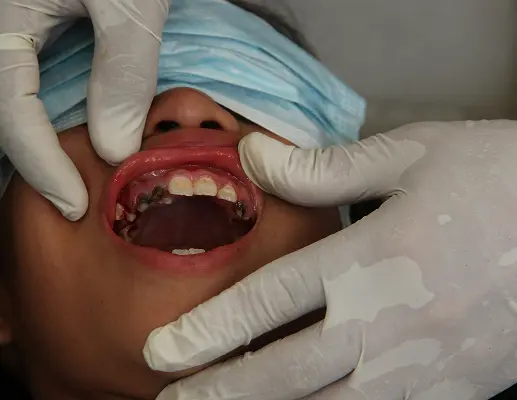 Gum Disease Treatment